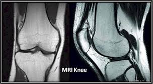 Find out how the different structures fit together in our knee diagram the knee joint is the largest and one of the most complex joints in the human body. Swslhd Medical Imaging Mri Knee