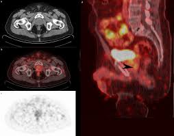 68ga psma pet ct in early relapsed