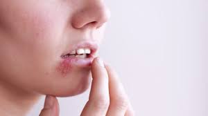get rid of lip pimples swollen big