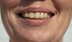 A white spot on the tooth may occur due to many reasons such as poor oral hygiene, eating baking soda is one of the most unusual yet best answer for how to get rid of white spots on a major cause of white spots on teeth in toddlers is fluorosis. Dental Fluorosis Treatment White Spots On Teeth Porcelain Veneers Cosmetic Dentist
