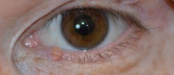 eyelid papilloma causes diagnosis