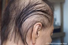 radiation induced hair loss