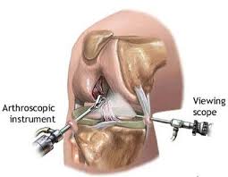 knee meniscus surgeries aptiva health