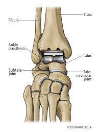 ankle replacement ankle arthritis