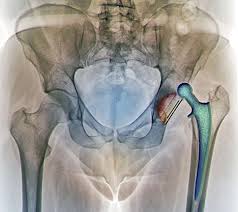 dislocation of a hip replacement implant