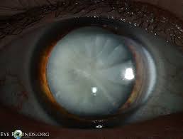 Mature Cortical Cataract