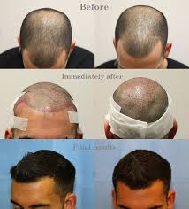 By 8 months, a hair transplant patient should have a fairly good idea of the growth. Hair Growth After Hair Transplant After Follicular Transfer Fue Hair Transplant