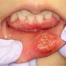 a photograph of the lower lip lesion of