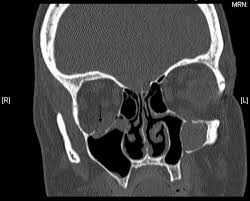 orbital floor fracture with periorbital