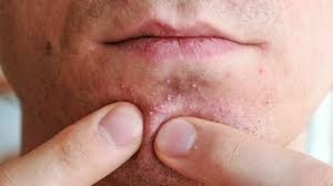 Das rasieren der schamhaare ist eine mögliche ursache für follikulitis. Akne Inversa Chronische Entzundung Der Haut Zava Dred