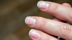 nail pitting causes treatment and