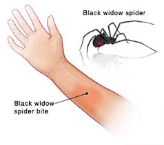 Black widow venom contains neurotoxins (toxins that act on the nervous system) called latrotoxins. Black Widow Spider Bite