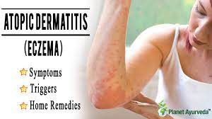 atopic dermais eczema symptoms