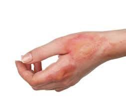 burns view causes symptoms and