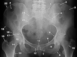 Pelvic xray anatomy to download pelvic xray anatomy just right click and save image as. Radiographic Anatomy Of Adult Pelvis Orthopaedicsone Articles Orthopaedicsone