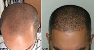 One thing to know is the timeline of growth and what you. Body Hair Transplantation Bht Alvi Armani Hair Transplant Los Angeles
