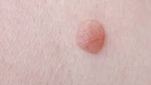 warts vs skin cancer can a wart be