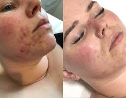 acne nicole s skin journey silver