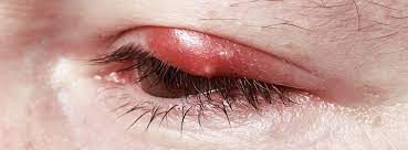 Bultje bij je oog / zwelling in je ooglid? Oorzaken en behandelingen