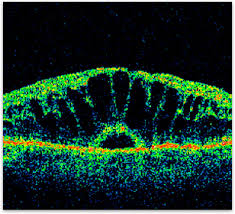 cystoid macular edema retina vitreous