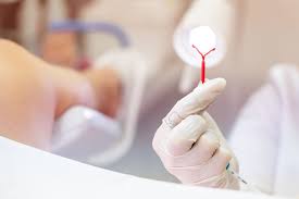 iud removal does it hurt 9 questions