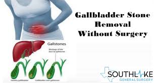 gallstone treatment and gallbladder removal