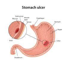 stomach ulcer symptoms