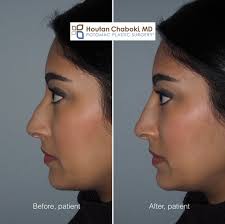 After gum recontouring surgery, the smile becomes more feminine with more of the teeth showing and less gums. Fillers To Improve Nasal Profile In Rhinoplasty