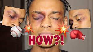 easy black eye bruised eye prank