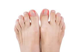 ingrown toenails for burbank