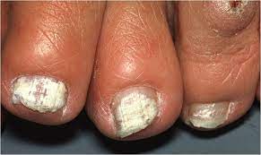 onychomycosis tinea unguium nail