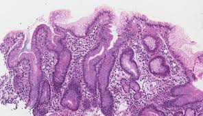 Intestinal metaplasia | Pathology dictionary | MyPathologyReport.ca