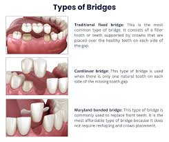 dental bridges in brooklyn ny tooth