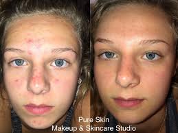 effective acne treatment program pure