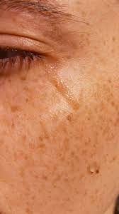 home remes for dark spots on face