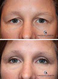 upper eyelid surgery in philadelphia