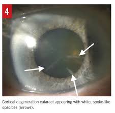 The Aging Crystalline Lens A Review Of Cataracts