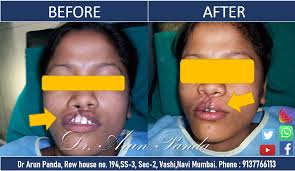 cleft repair surgery in navi mumbai