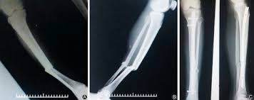 open tibia fractures