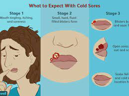 cold sore outbreaks causes symptoms