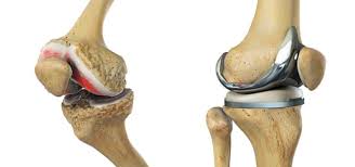 knee replacement north tees and