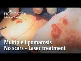 multiple lipomatosis no scars laser