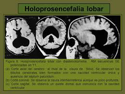 Resultado de imagem para imagem holoprosencefalia alobar