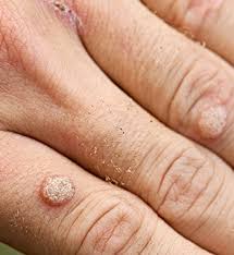 warts richmond dermatology