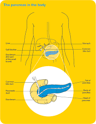 Symptoms include jaundice, pain, and in this article, learn more about the signs and symptoms of pancreatic cancer, as well as the causes in distal pancreatectomy, the surgeon removes part of the pancreas and usually the spleen as well. Pancreatic Cancer Overview Cancer Council Victoria