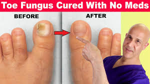 toe nail fungus cured with no meds dr