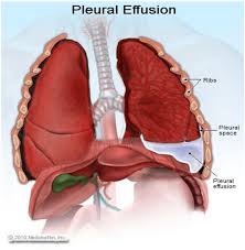 Mengenal penyakit paru paru basah pneumonia. Masalah Paru Paru Berair Isteri Bertegas Tidak Mahu Suami Ditebuk Miazain