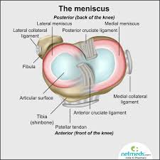 torn meniscus causes symptoms and