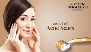 dermaroller to fill indented acne scars