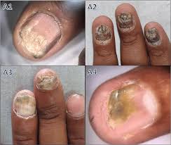 nail whispers revealing dermatological